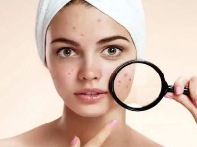 Black Spots On Face | चेहऱ्यावरील वांग | हे घरगुती उपाय करून चेहरा बनवा सुंदर