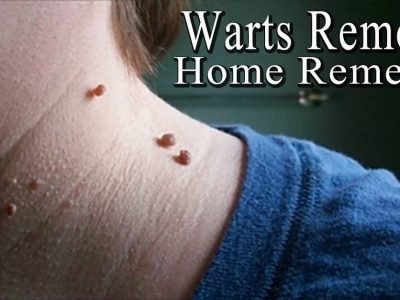 Home Remedies on Warts | शरीरावरील चामखीळ काढण्यासाठी काही घरगुती उपाय