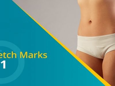 Health First | स्ट्रेच मार्क्स? | आता चिंता सोडा आणि ह्या टिप्स वापरून पहा – नक्की वाचा