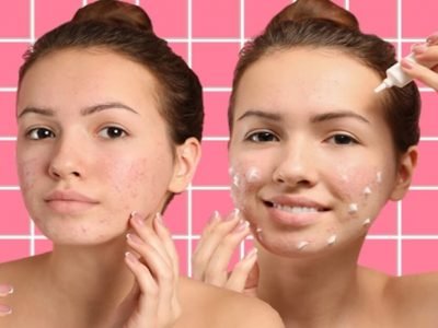 Pimple Patch | पॅच ट्रीटमेंटमुळे पिंपल्स पासून एका रात्रीत सुटका होते? जाणून घ्या कसे वापरावे