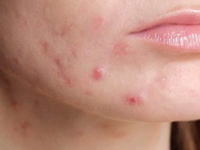 Health First | चेहऱ्यावरील मुरूम नाहीसे करण्यासाठी करा हे घरगुती उपाय । नक्की वाचा