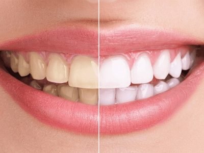 Teeth Care Tips | रोज ब्रश केल्यावरही अनेक वेळा दात पिवळे दिसतात, घरगुती टिप्स फॉलो करून दातांचा पिवळेपणा करा दूर