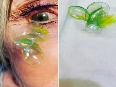 Viral Video | निष्काळजीपणा भोवला, महिलेच्या डोळ्यात अडकलेल्या तब्बल 23 कॉन्टॅक्ट लेन्सेस डॉक्टरांनी अशा काढल्या, पहा व्हिडीओ