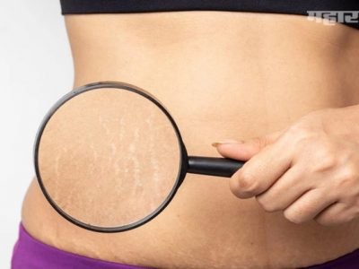 Health First | वजन घटवताना हमखास होणारे स्ट्रेच मार्क टाळण्यासाठी | खास टीप्स